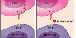 Left frame: Normally, tumor cells (purple) evade the immune system’s T cells (pink) by expressing a checkpoint protein known as PD-L1. Right frame: Atezolizumab (Tecentriq) binds to PD-L1 and blocks it from binding to another checkpoint protein, PD-1. This helps T cells regain their ability to kill tumor cells.