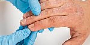 Dermatologist examining patient's hand with gloves
